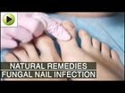 Home Remedies for Fungal Nail Infection