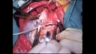 1965 Footage Of Heart Surgery On An 11-Year-Old In Canada