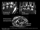 Radiology of Psoriatic Arthritis