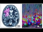 Researchers find that brain activity promotes the growth of brain cancer