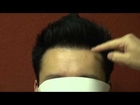Amazing FUE Hair Transplant Result Bald Asian Man Frontal Hair Loss Dr. Diep www.mhtaclinic.com