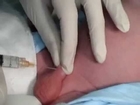 Infant Circumcision Operation