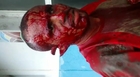 BRAZIL >> Man gets attacked with a MACHETE = hand almost chopped off =