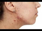 Natural Adult Acne Treatment | Adult Acne Home Remedies