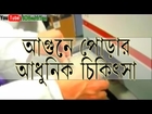 Nanotechnology for Burned Patient Treatment Bangla Health Tips