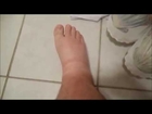 Heal SWOLLEN Legs Ankles Feet NATURALLY (edema cure fix heart disease kidney liver walking help diet